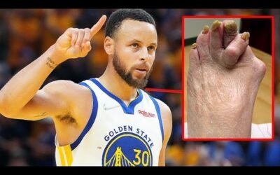 Why Do Nba Players Have Bad Feet