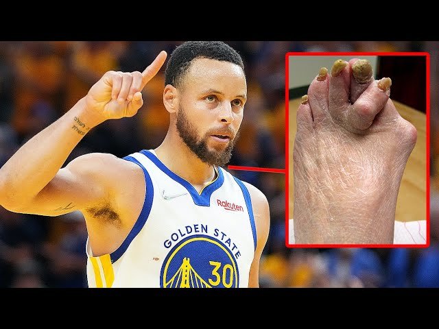 Why Do Nba Players Have Bad Feet